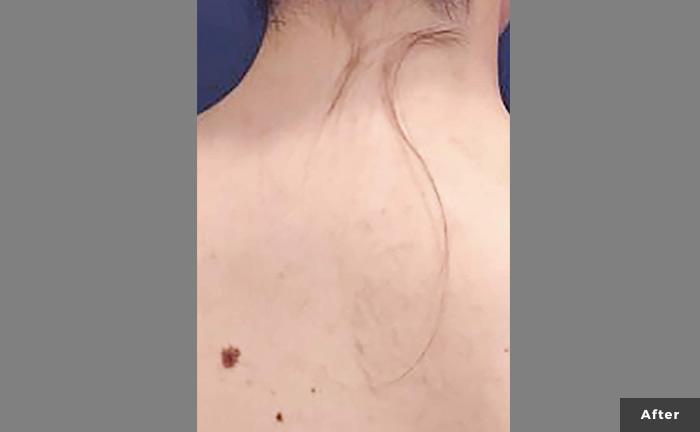 Laser tattoo removal at NoSweat Fort Wayne Another example of the gradual  fading of a large upper arm tattoo Remember the process always takes   By NoSweatFW  Facebook  Heres a